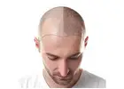 best hair transplant in pakistan