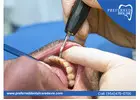 Say Goodbye to Decay with Expert Cavity Protection Service