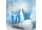 Leading Quality Dental Implant Suppliers in Mexico Today